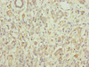 Immunohistochemistry of paraffin-embedded human pancreatic cancer using CSB-PA745333DSR1HU at dilution of 1:100