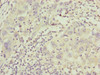 Immunohistochemistry of paraffin-embedded human liver cancer using CSB-PA810295ESR1HU at dilution of 1:100
