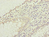 Immunohistochemistry of paraffin-embedded human colon cancer using CSB-PA873706ESR1HU at dilution of 1:100