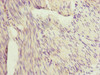 Immunohistochemistry of paraffin-embedded human bladder cancer using CSB-PA873706ESR2HU at dilution of 1:100