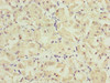 Immunohistochemistry of paraffin-embedded human gastric cancer using CSB-PA882183ESR1HU at dilution of 1:100