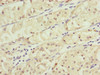 Immunohistochemistry of paraffin-embedded human gastric cancer using CSB-PA882183ESR2HU at dilution of 1:100