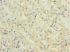 Immunohistochemistry of paraffin-embedded human gastric cancer using CSB-PA880157ESR1HU at dilution of 1:100