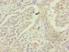 Immunohistochemistry of paraffin-embedded human lung cancer using CSB-PA014908ESR1HU at dilution of 1:100