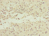 Immunohistochemistry of paraffin-embedded human glioma using CSB-PA822820DSR2HU at dilution of 1:100