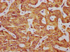 IHC image of CSB-PA861174DSR1HU diluted at 1:325 and staining in paraffin-embedded human liver cancer performed on a Leica BondTM system. After dewaxing and hydration, antigen retrieval was mediated by high pressure in a citrate buffer (pH 6.0) . Section was blocked with 10% normal goat serum 30min at RT. Then primary antibody (1% BSA) was incubated at 4°C overnight. The primary is detected by a biotinylated secondary antibody and visualized using an HRP conjugated SP system.
