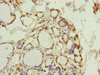 Immunohistochemistry of paraffin-embedded human thyroid tissue using CSB-PA017861ESR2HU at dilution of 1:100