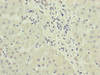 Immunohistochemistry of paraffin-embedded human liver cancer using CSB-PA896533ESR2HU at dilution of 1:100