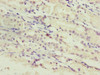 Immunohistochemistry of paraffin-embedded human gastric cancer using CSB-PA836171ESR1HU at dilution of 1:100