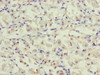 Immunohistochemistry of paraffin-embedded human gastric cancer using CSB-PA836171ESR2HU at dilution of 1:100