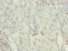 Immunohistochemistry of paraffin-embedded human bladder cancer using CSB-PA021132ESR1HU at dilution of 1:100