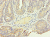 Immunohistochemistry of paraffin-embedded human endometrial cancer using CSB-PA021132ESR2HU at dilution of 1:100