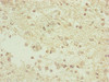 Immunohistochemistry of paraffin-embedded human glioma using CSB-PA856905ESR2HU at dilution of 1:100