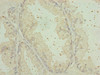 Immunohistochemistry of paraffin-embedded human prostate cancer using CSB-PA822707ESR1HU at dilution of 1:100