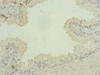 Immunohistochemistry of paraffin-embedded human prostate cancer using CSB-PA822707ESR2HU at dilution of 1:100