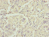 Immunohistochemistry of paraffin-embedded human liver cancer using CSB-PA621975ESR1HU at dilution of 1:100