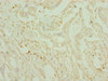 Immunohistochemistry of paraffin-embedded human pancreatic cancer using CSB-PA621975ESR1HU at dilution of 1:100
