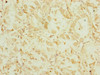 Immunohistochemistry of paraffin-embedded human gastric cancer using CSB-PA007433ESR2HU at dilution of 1:100