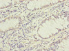 Immunohistochemistry of paraffin-embedded human colon cancer using CSB-PA875707ESR2HU at dilution of 1:100
