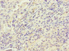 Immunohistochemistry of paraffin-embedded human lung cancer using CSB-PA010471ESR1HU at dilution of 1:100