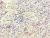 Immunohistochemistry of paraffin-embedded human lung cancer using CSB-PA010471ESR2HU at dilution of 1:100