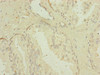 Immunohistochemistry of paraffin-embedded human prostate cancer using CSB-PA013835ESR1HU at dilution of 1:100