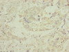 Immunohistochemistry of paraffin-embedded human pancreatic cancer using CSB-PA013835ESR1HU at dilution of 1:100