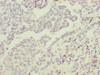 Immunohistochemistry of paraffin-embedded human lung cancer using CSB-PA862000ESR1HU at dilution of 1:100
