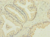 Immunohistochemistry of paraffin-embedded human prostate cancer using CSB-PA862000ESR2HU at dilution of 1:100