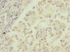 Immunohistochemistry of paraffin-embedded human lung cancer using CSB-PA862000ESR2HU at dilution of 1:100