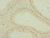 Immunohistochemistry of paraffin-embedded human prostate cancer using CSB-PA017716ESR2HU at dilution of 1:100