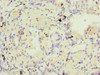 Immunohistochemistry of paraffin-embedded human lung cancer using CSB-PA732918ESR1HU at dilution of 1:100