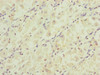 Immunohistochemistry of paraffin-embedded human gastric cancer using CSB-PA732918ESR1HU at dilution of 1:100