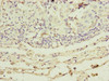 Immunohistochemistry of paraffin-embedded human lung cancer using CSB-PA732918ESR2HU at dilution of 1:100