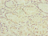 Immunohistochemistry of paraffin-embedded human gastric cancer using CSB-PA732918ESR2HU at dilution of 1:100