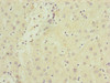 Immunohistochemistry of paraffin-embedded human liver cancer using CSB-PA896898ESR2HU at dilution of 1:100