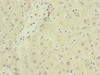 Immunohistochemistry of paraffin-embedded human liver cancer using CSB-PA896898ESR2HU at dilution of 1:100