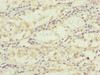 Immunohistochemistry of paraffin-embedded human gastric cancer using CSB-PA023551ESR1HU at dilution of 1:100