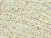 Immunohistochemistry of paraffin-embedded human gastric cancer using CSB-PA023551ESR2HU at dilution of 1:100