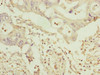 Immunohistochemistry of paraffin-embedded human pancreatic cancer using CSB-PA623014DSR1HU at dilution of 1:100