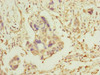 Immunohistochemistry of paraffin-embedded human pancreatic cancer using CSB-PA623014DSR2HU at dilution of 1:100