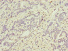 Immunohistochemistry of paraffin-embedded human lung cancer using CSB-PA002355ESR2HU at dilution of 1:100