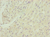 Immunohistochemistry of paraffin-embedded human liver cancer using CSB-PA004195ESR1HU at dilution of 1:100
