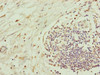 Immunohistochemistry of paraffin-embedded human pancreatic cancer using CSB-PA004195ESR1HU at dilution of 1:100