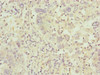 Immunohistochemistry of paraffin-embedded human liver cancer using CSB-PA004195ESR2HU at dilution of 1:100