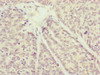 Immunohistochemistry of paraffin-embedded human ovarian cancer using CSB-PA005862ESR1HU at dilution of 1:100