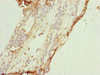 Immunohistochemistry of paraffin-embedded human breast cancer using CSB-PA005862ESR1HU at dilution of 1:100