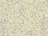 Immunohistochemistry of paraffin-embedded human liver cancer using CSB-PA854115ESR1HU at dilution of 1:100