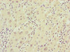 Immunohistochemistry of paraffin-embedded human liver cancer using CSB-PA854115ESR1HU at dilution of 1:100