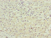 Immunohistochemistry of paraffin-embedded human liver cancer using CSB-PA854115ESR2HU at dilution of 1:100